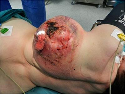 Giant bleeding post-traumatic thoracic sarcoma management: A case report